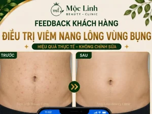 Điều Trị Viêm Nang Lông Hải Phòng – Giải Pháp Cho Vùng Da Thô Ráp Và Lông Mọc Ngược