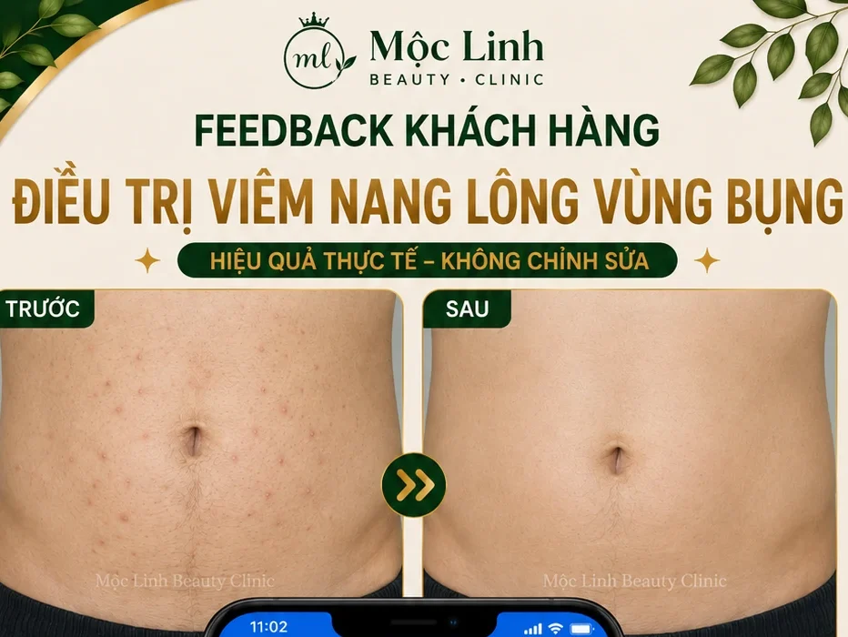 Điều Trị Viêm Nang Lông Hải Phòng – Giải Pháp Cho Vùng Da Thô Ráp Và Lông Mọc Ngược