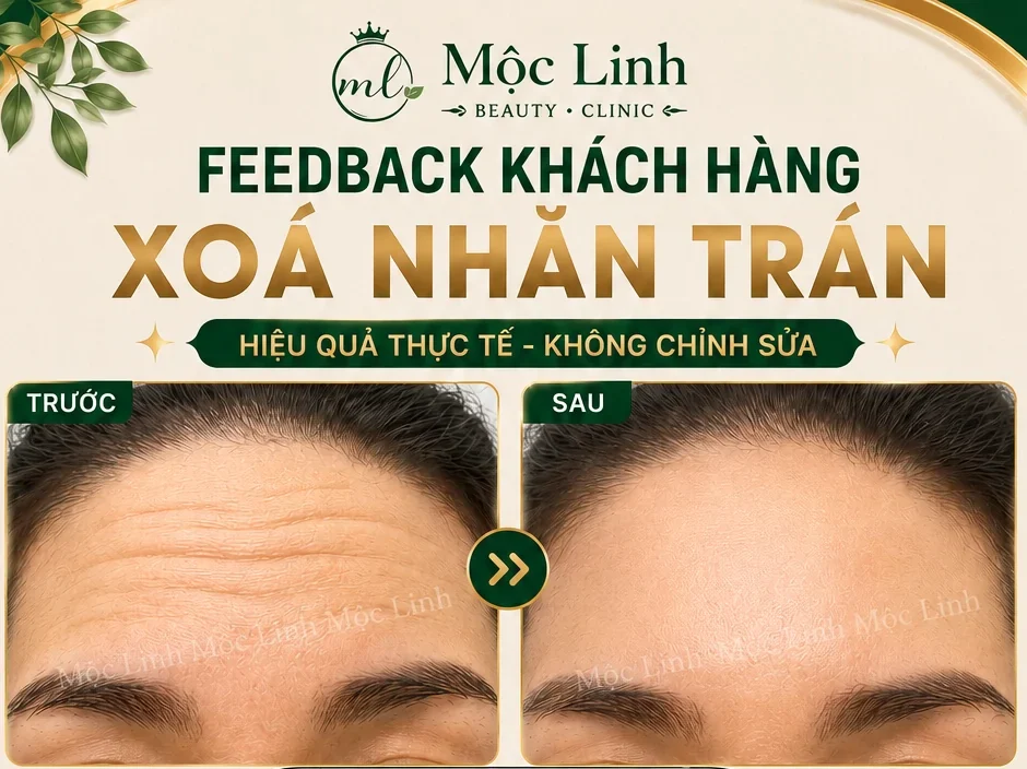 Xóa Nhăn Hải Phòng