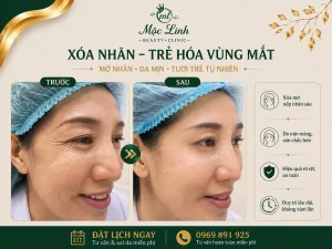 Xóa Nhăn Hải Phòng