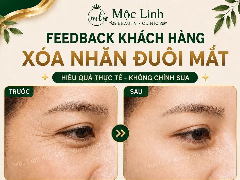 Xóa Nhăn Hải Phòng