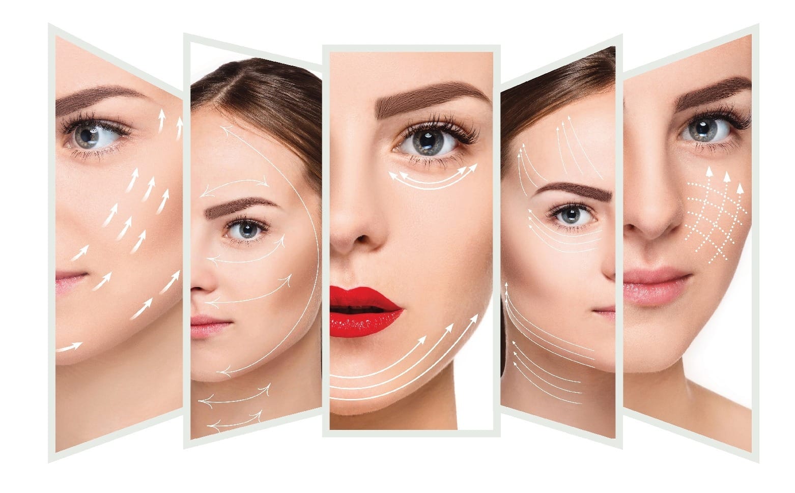 Căng chỉ collagen: Ưu nhược điểm & Giá cấy chỉ Collagen