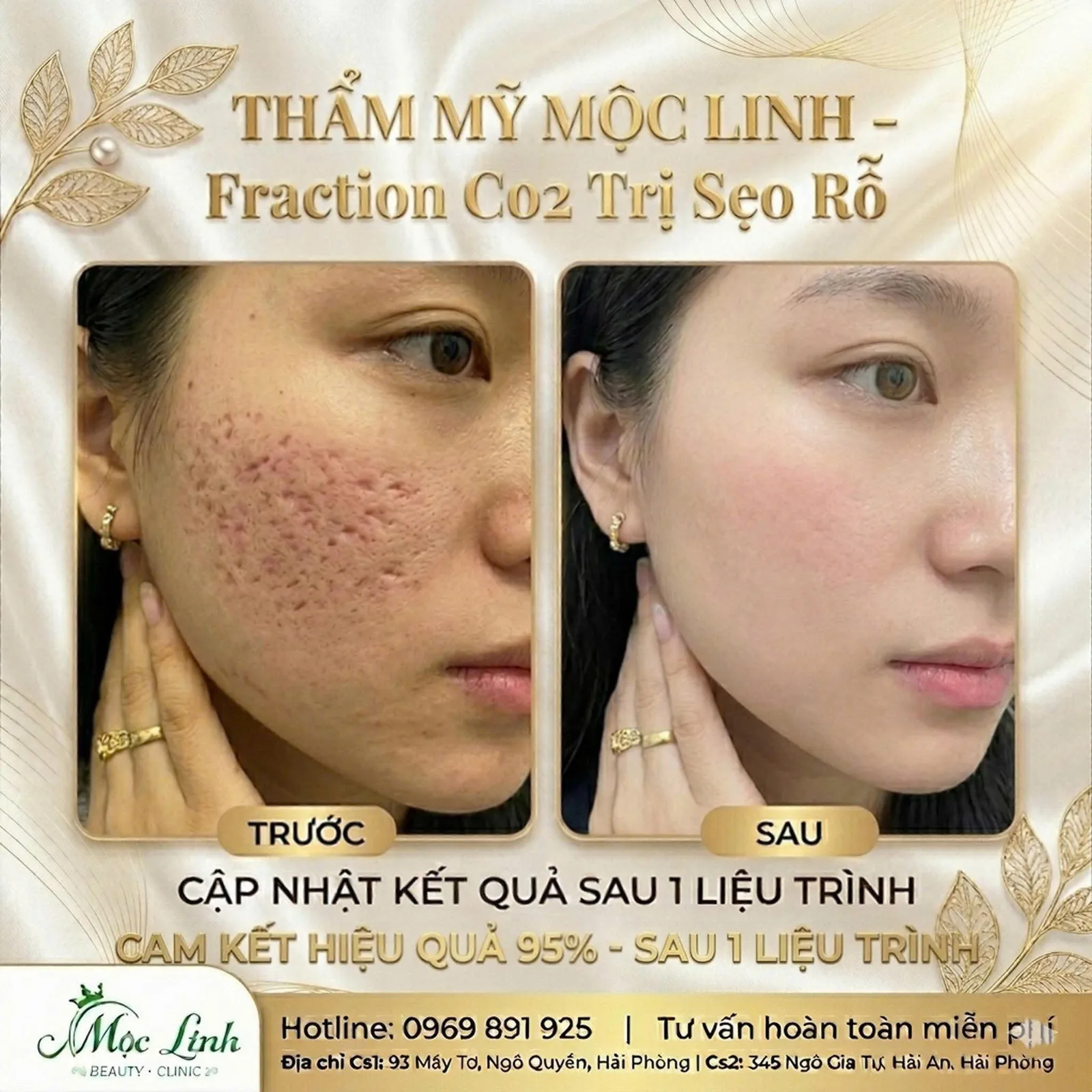 Công nghệ laser CO2 điều trị sẹo rỗ tại Hải Phòng