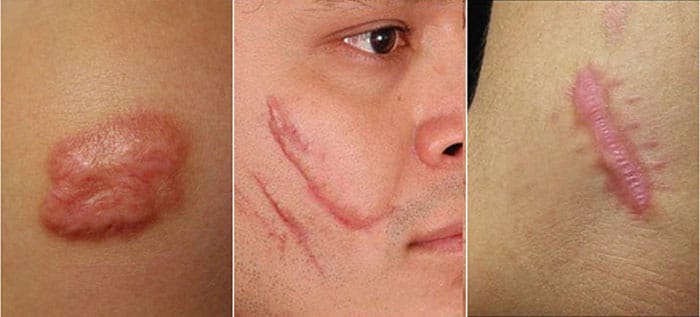 Điều trị sẹo công nghệ cao - Giải pháp xoá nhanh mọi loại sẹo - BVTM JW