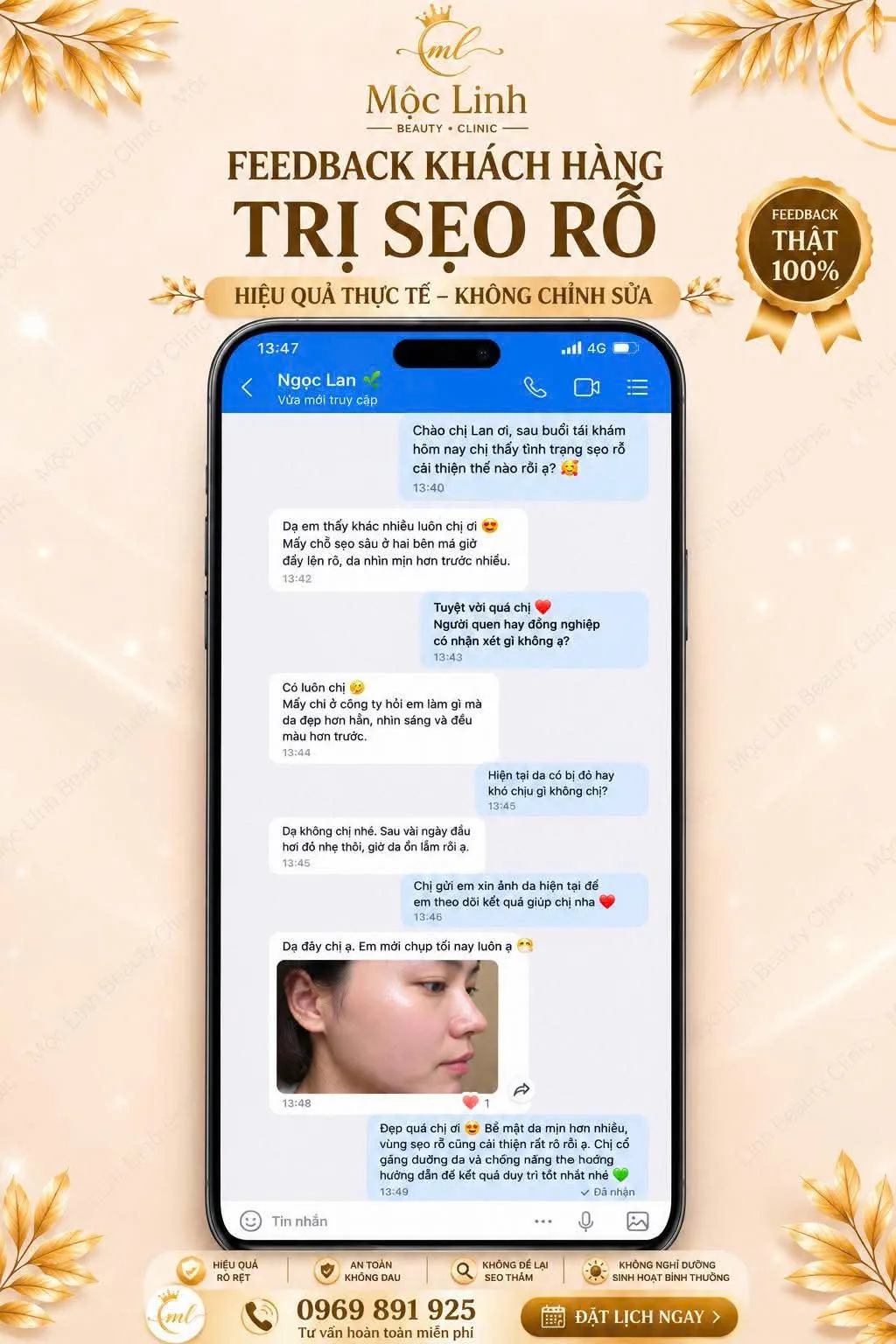Điều trị sẹo rỗ chuẩn y khoa tại Thẩm Mỹ Mộc Linh Hải Phòng